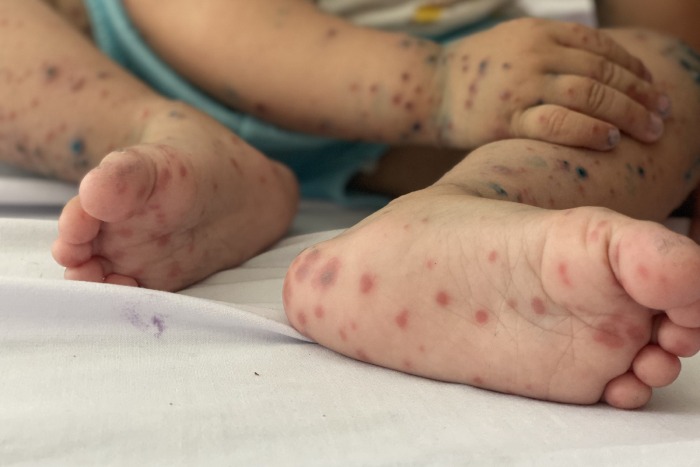 Sức khoẻ - Làm đẹp - Tin tức đời sống mới nhất ngày 26/9: Bé 3 tuổi mắc tay chân miệng tử vong sau 15 phút nhập viện